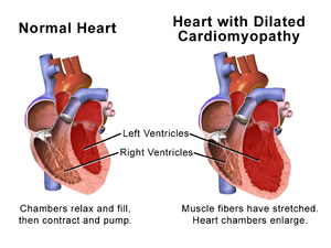 Dilated cardiomyopathy (DCM)