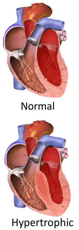 Hypertrophic cardiomyopathy (HCM)
