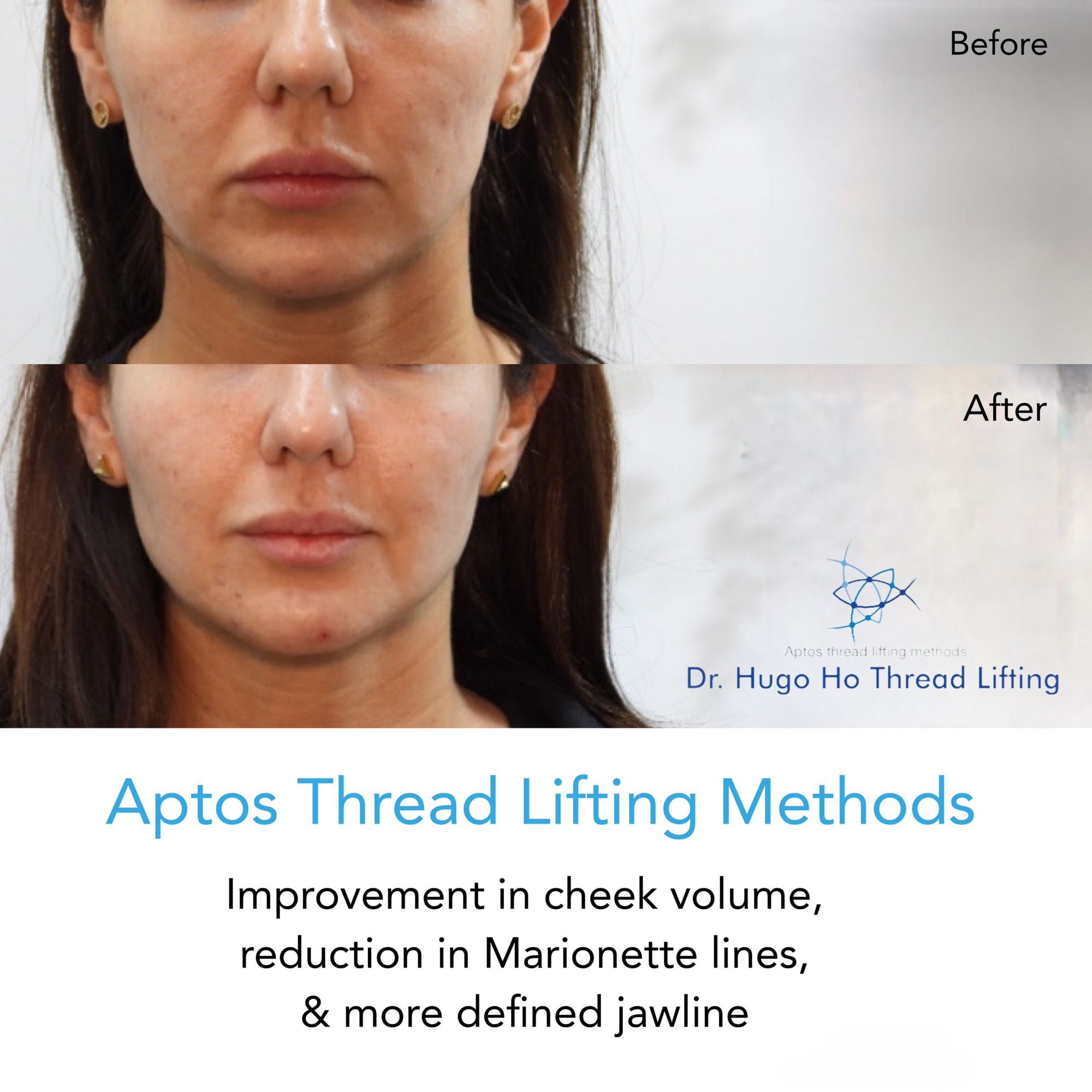 Aptos Thread Lifting Image -67a55d038dbd3