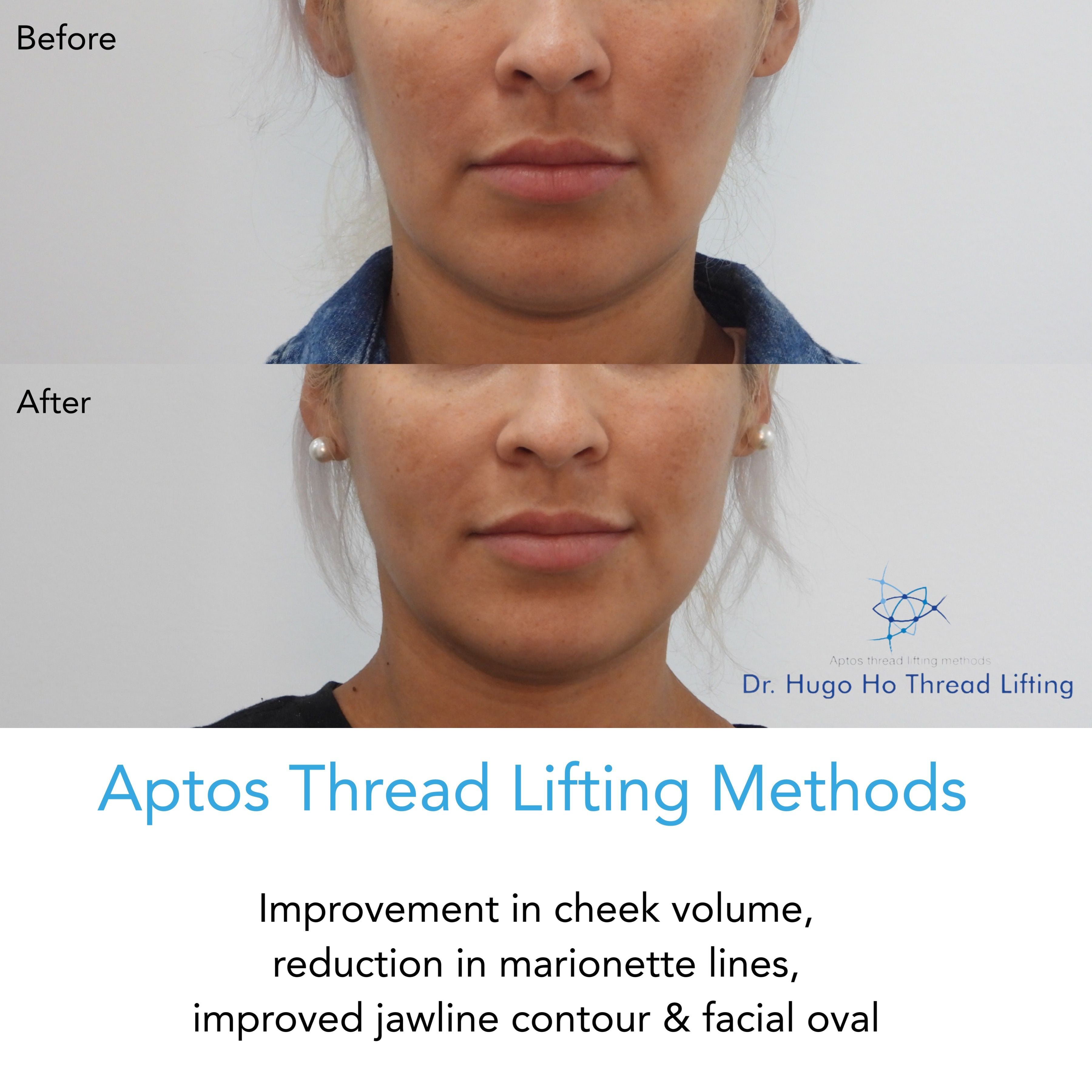 Aptos Thread Lifting Image -67a55d13f027d