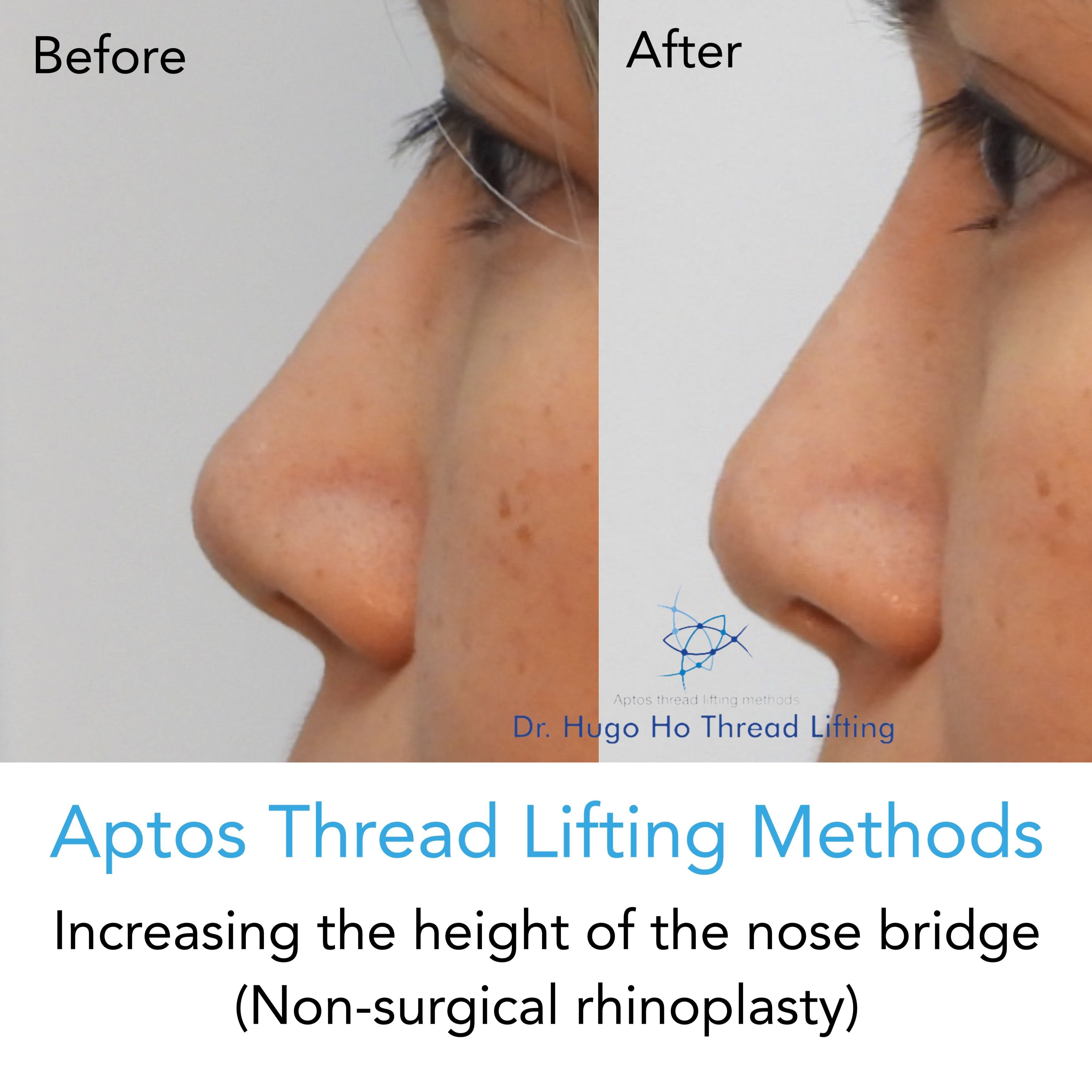 Aptos Thread Lifting Image -67a55d2e4b3df