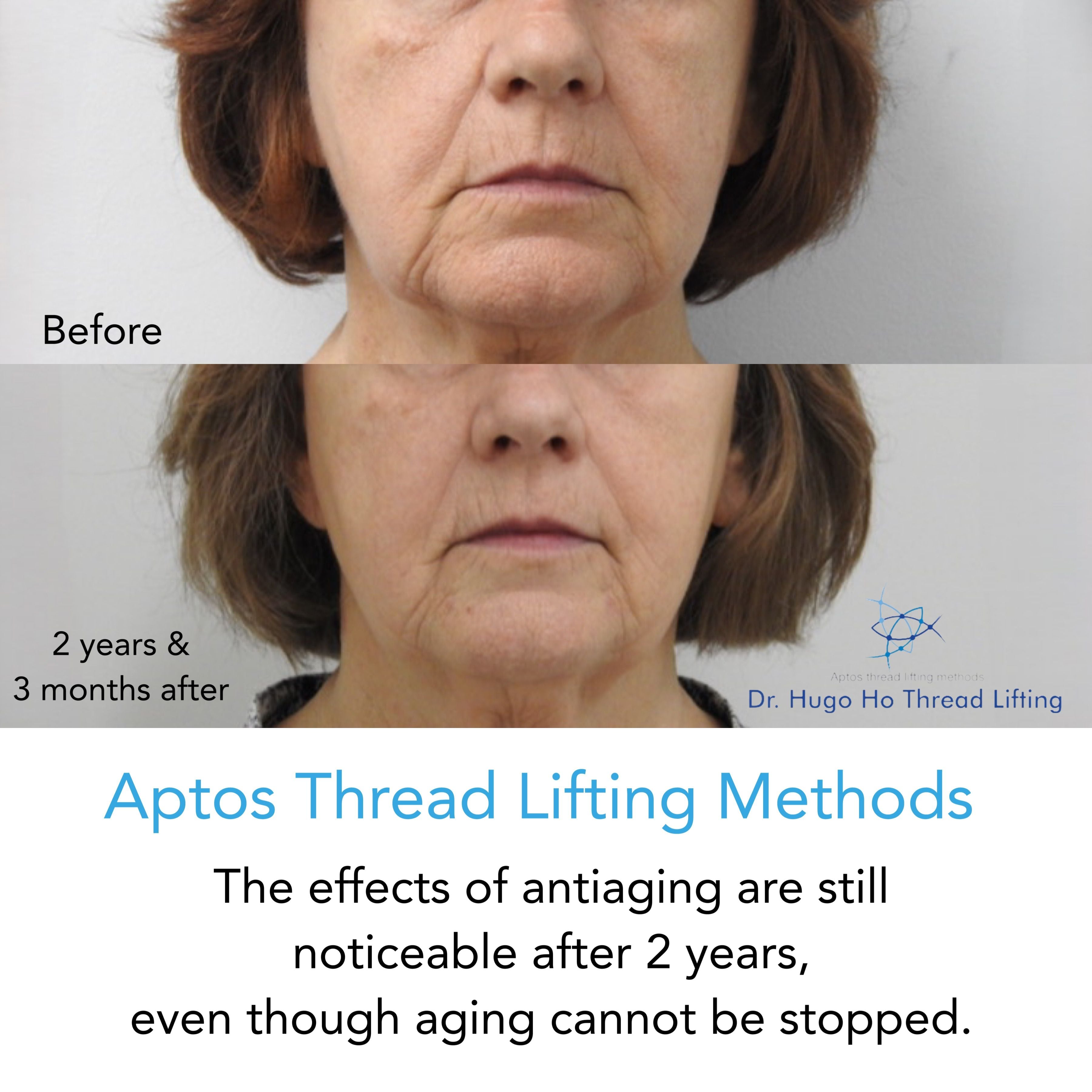 Aptos Thread Lifting Image -67a55d45942c4