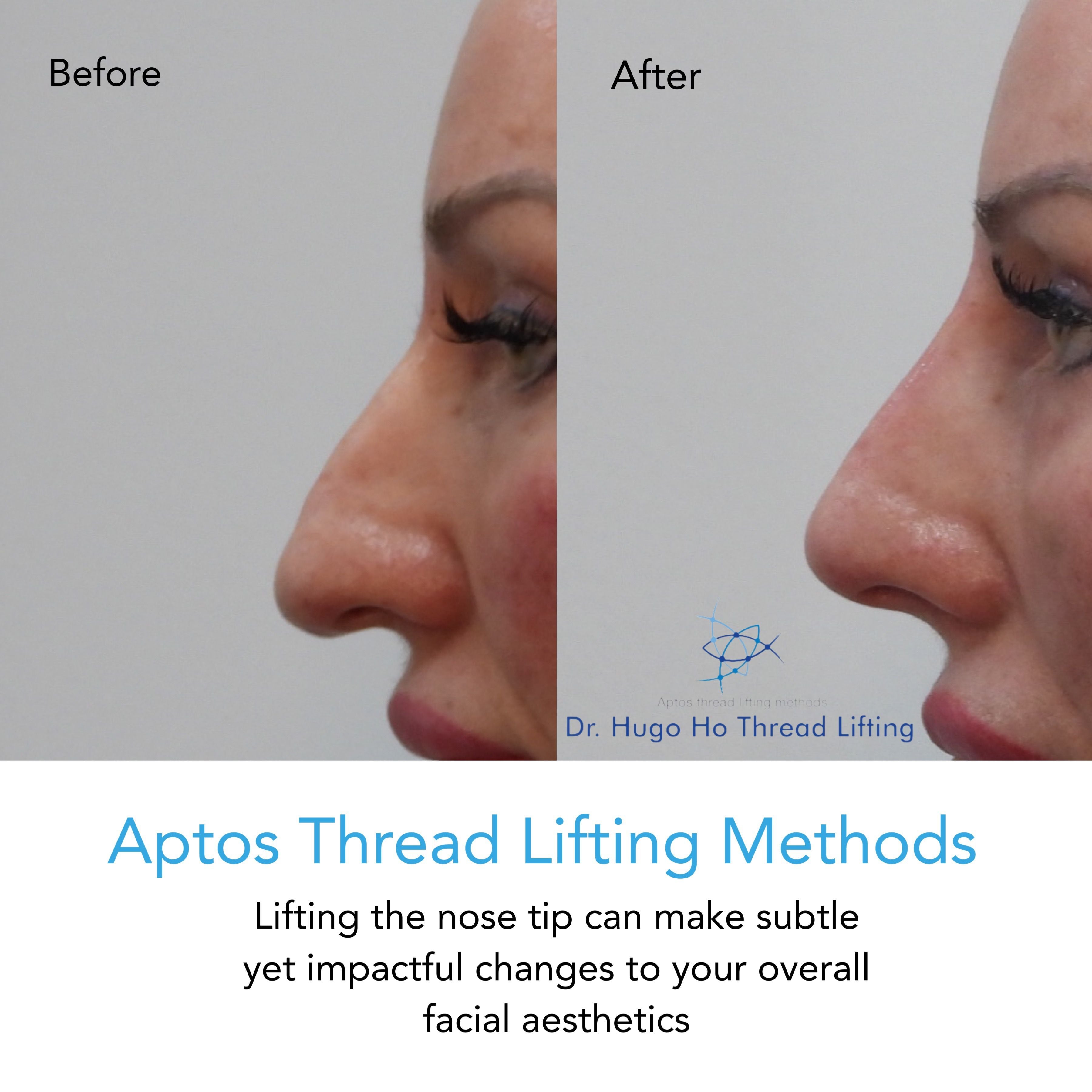 Aptos Thread Lifting Image -67a55d4c2b52a