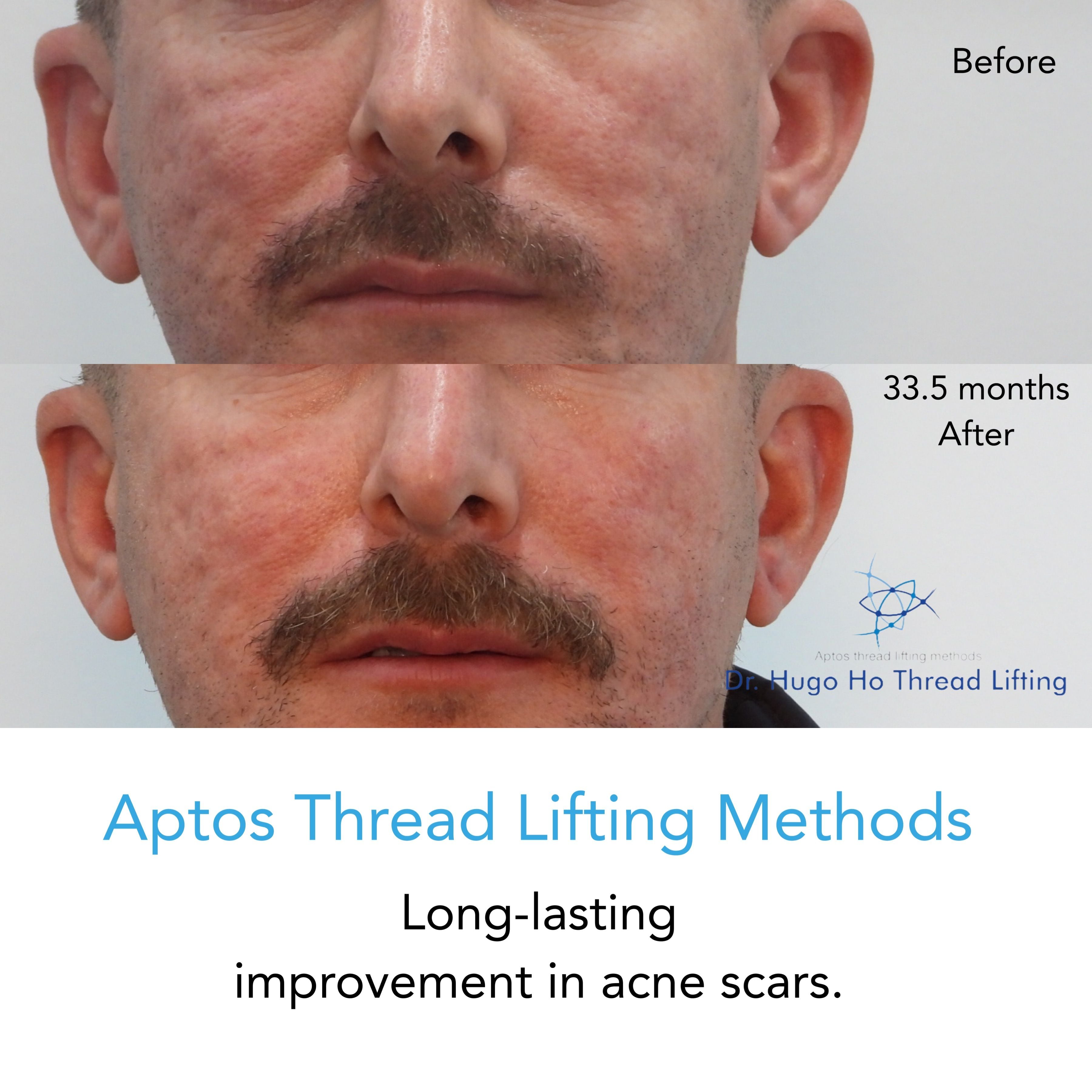 Aptos Thread Lifting Image -67a55d55ecfb2