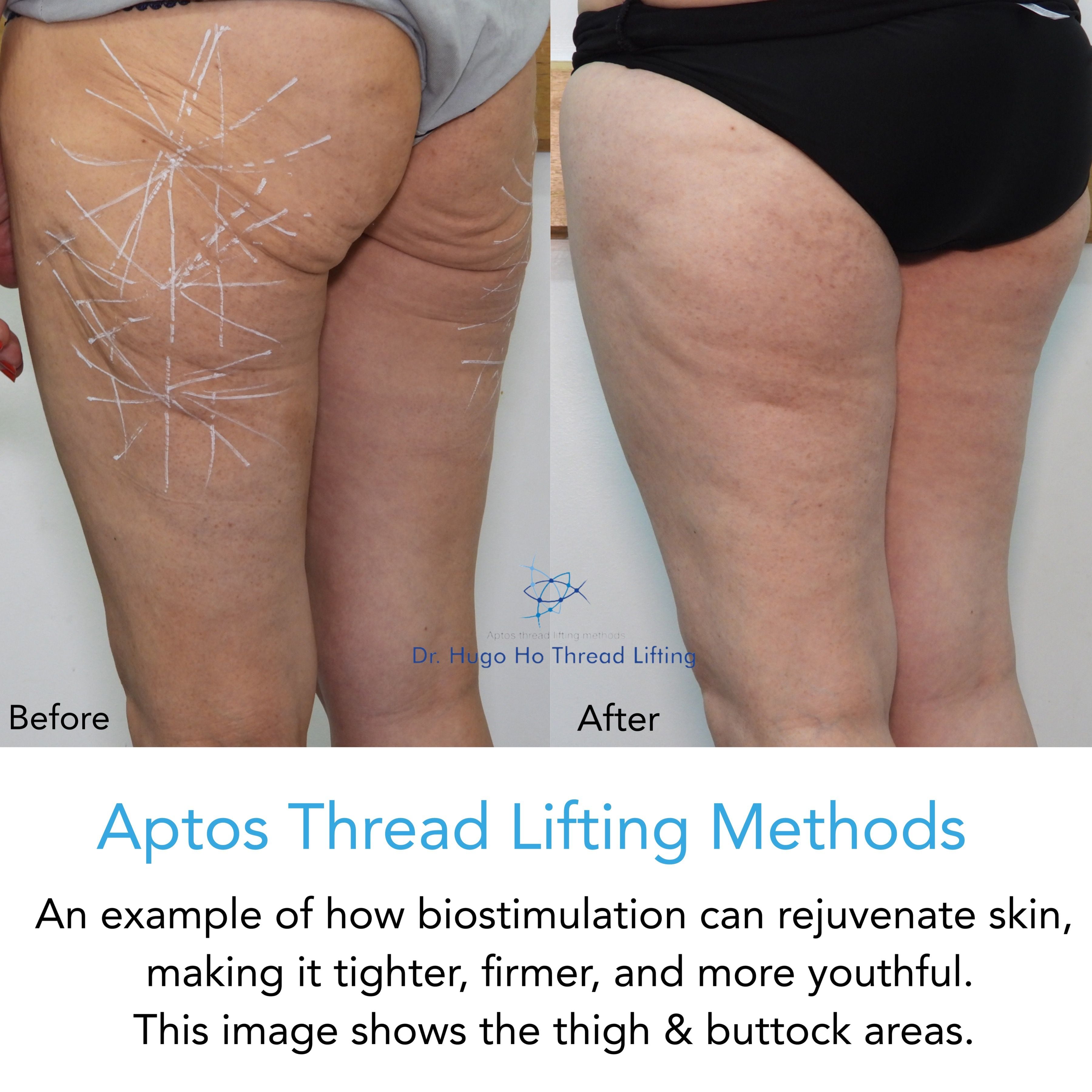 Aptos Thread Lifting Image -67a5602fe4d6e