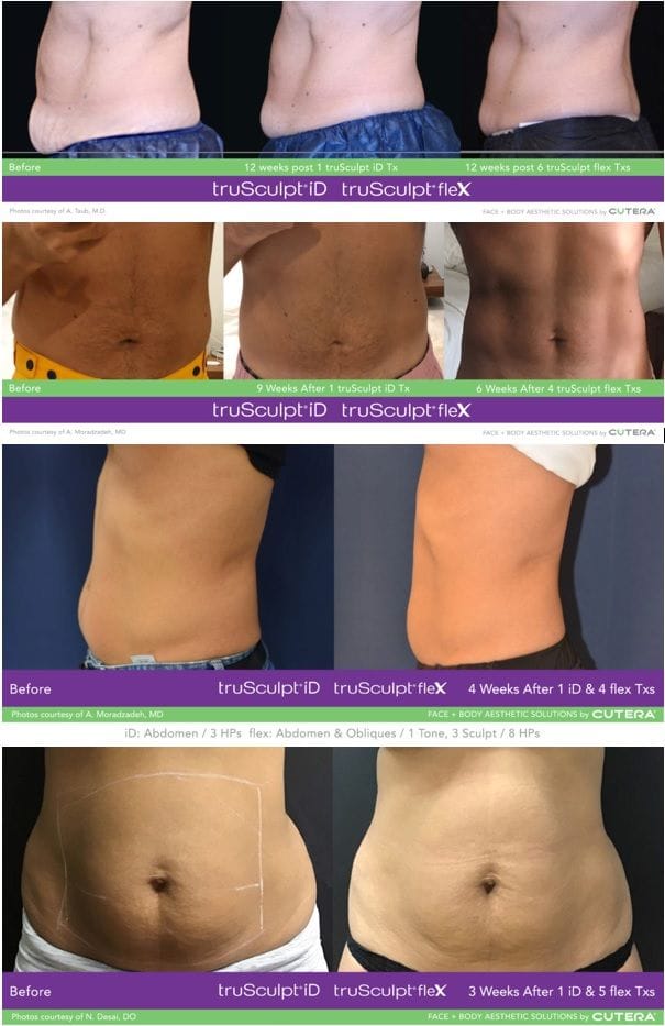 truSculpt ID Before & After Results images