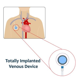 Implanted Venous Access Device (Port)