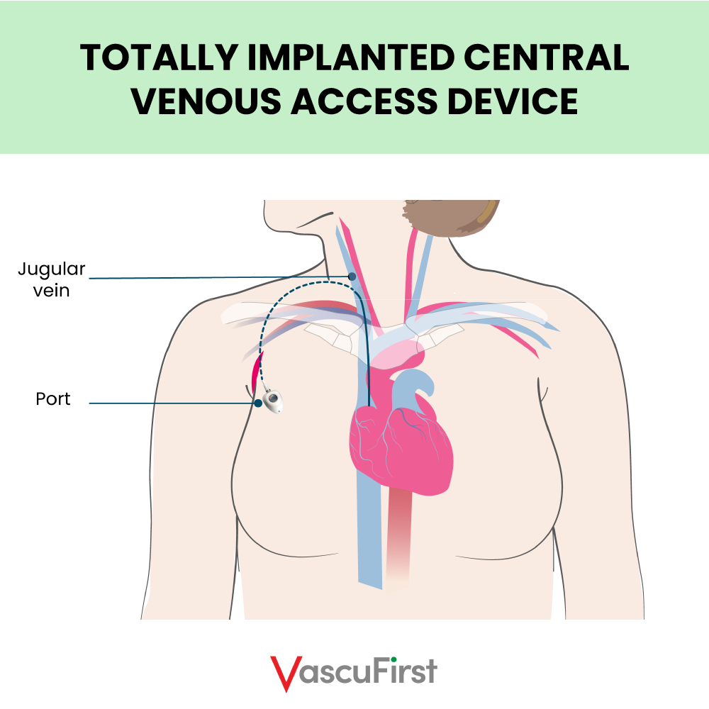 central venous catheter subclavian