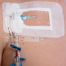 Should We Use Skin Glue to Secure Peripheral IVs? - REBEL EM