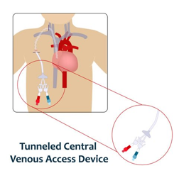 Differences Between Tunneled & Non-Tunneled Central Venous Catheters