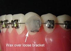 Orthodontic Troubleshooting