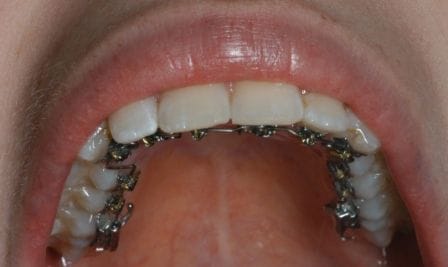 Lingual Braces  Contour Orthodontists