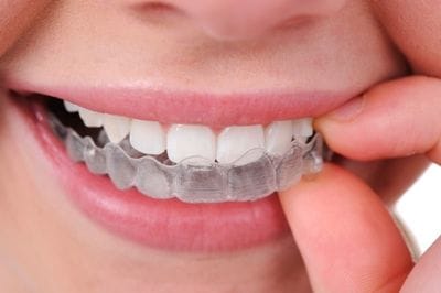 Come to Us for Invisalign in Pennant Hills