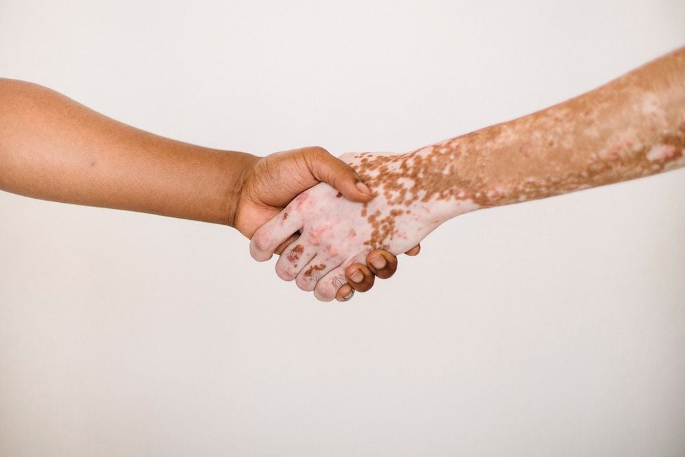 Avita Medical receives FDA green light for US trial of potential vitiligo treatment