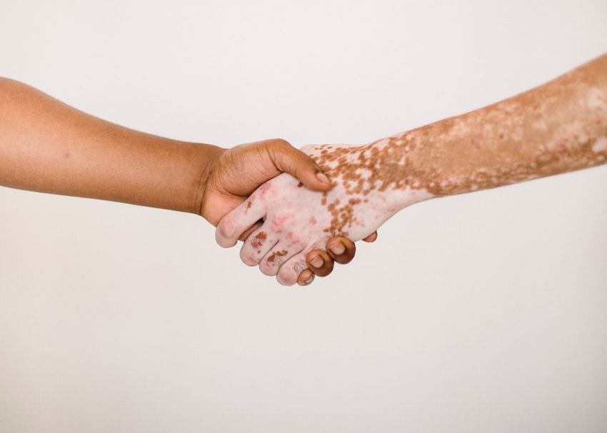 Avita Medical receives FDA green light for US trial of potential vitiligo treatment