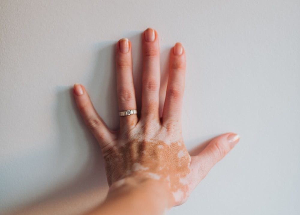 Aussie biotech approved by FDA to treat vitiligo