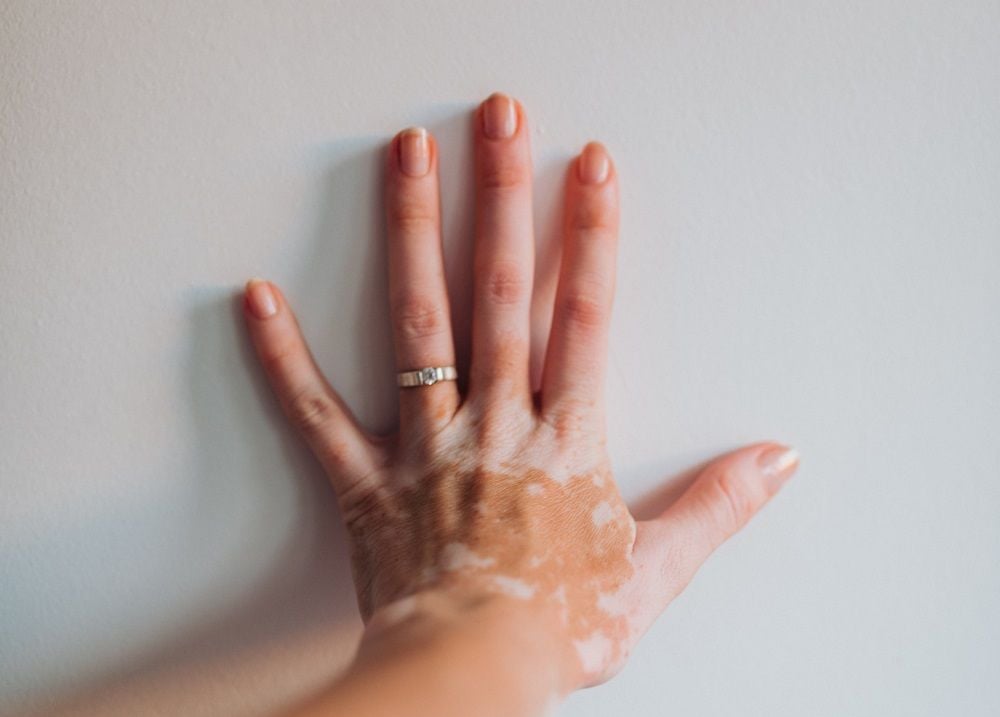 AVITA scores US FDA approval for vitiligo treatment