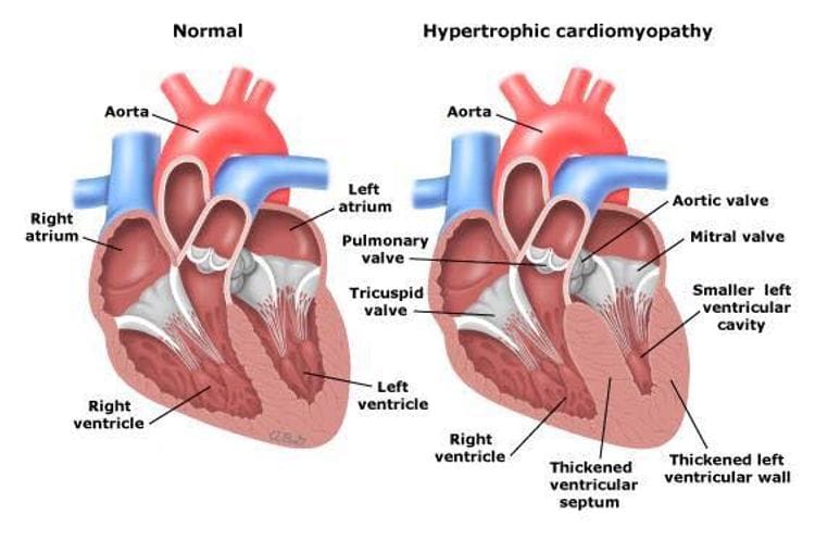 Hypertrophic cardiomyopathy