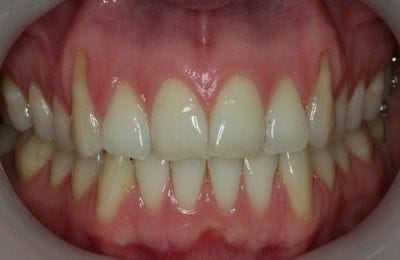 Gingival Grafting | Periodontics & Dental Implant Centre