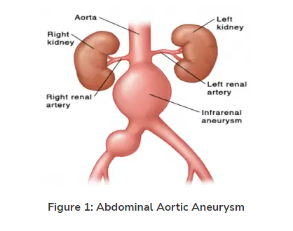 Abdominal Aortic Aneurysms | Melbourne Vascular Centre