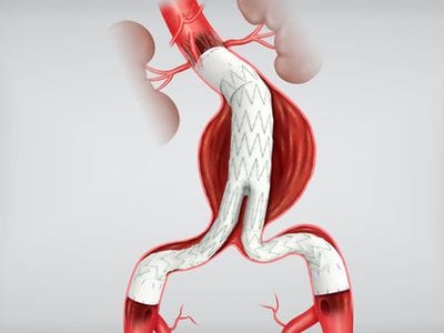 The Zenith Flex AAA Endograft (Cook Medical)