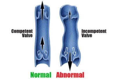 Comparison of a 'competent' vein and an 'incompetent' vein