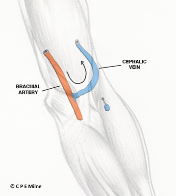 Arteriovenous Av Fistula Formation