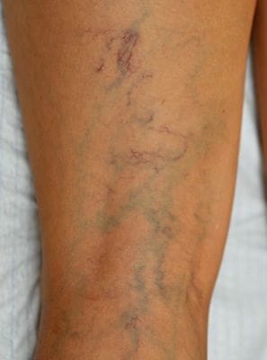 Sclerotherapy of spider veins - Vascular Care Centre