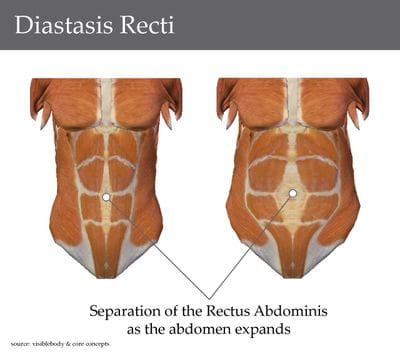 Understanding abdominal separation