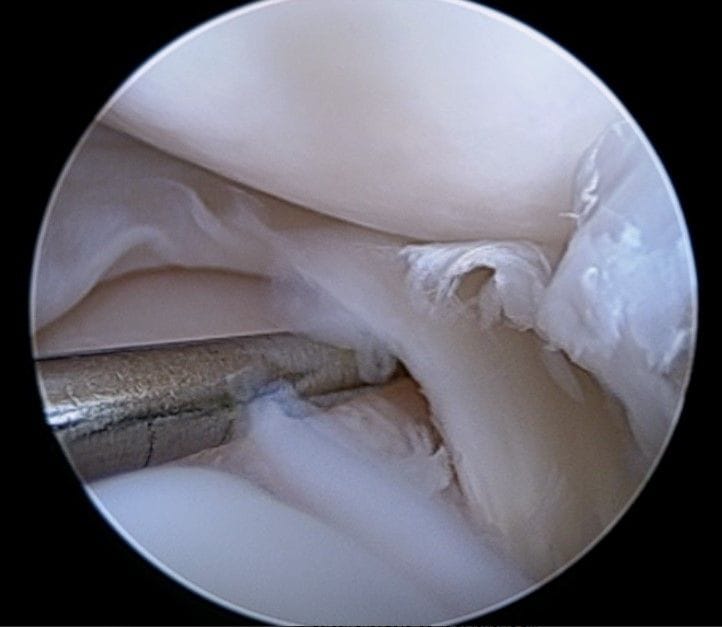 Cranial cruiciate ligament disease Cranial cruiciate ligament disease