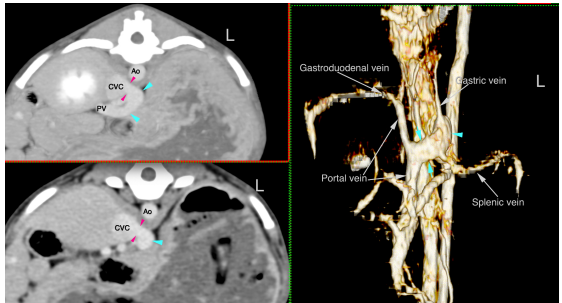 Transverse post-contrast images of the abdomen in soft tissue window and 3D reconstruction of the portal vasculature.