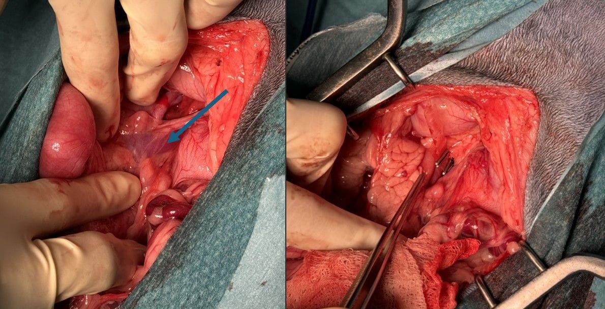 Gastrocaval PSS (blue arrow) on the left and cellophane banding on the right.