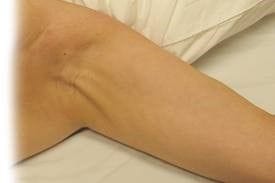 Cording After Breast Surgery: 7 Things To Know About Axillary Web