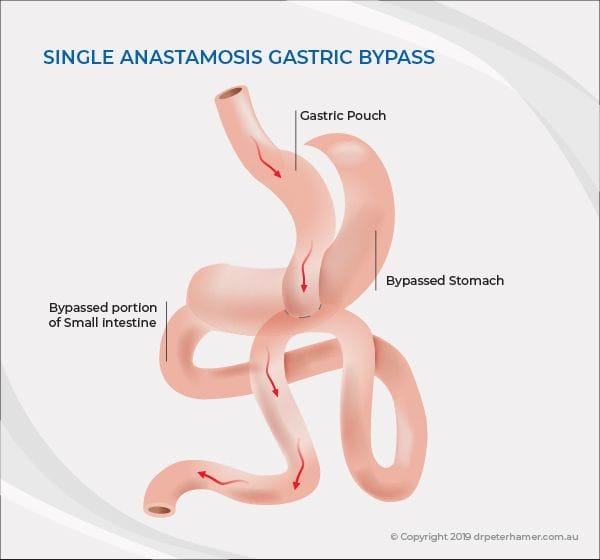 Gastric bypass | Dr Peter Hamer