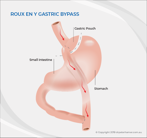 Gastric bypass | Dr Peter Hamer