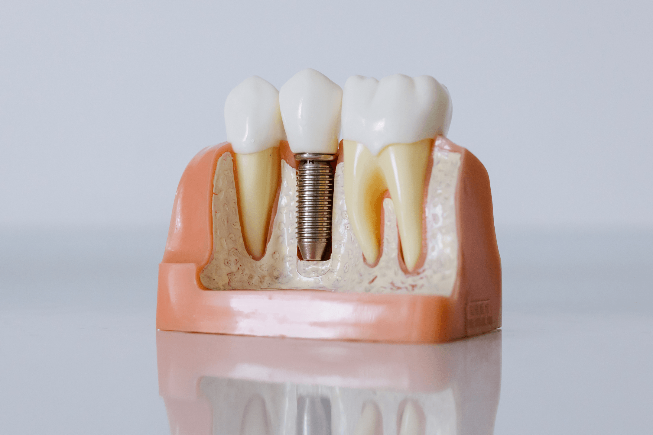 Dental Implants in Salisbury | Paralowie | Elizabeth South | Elizabeth Vale | Parafield Gardens | Brahma Lodge | Salisbury Park | Salisbury North | Salisbury Plain | Salisbury South | Salisbury Downs | Northern Adelaide SA