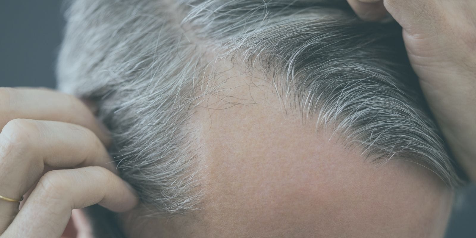 Close up on man's head showing receding hairline 