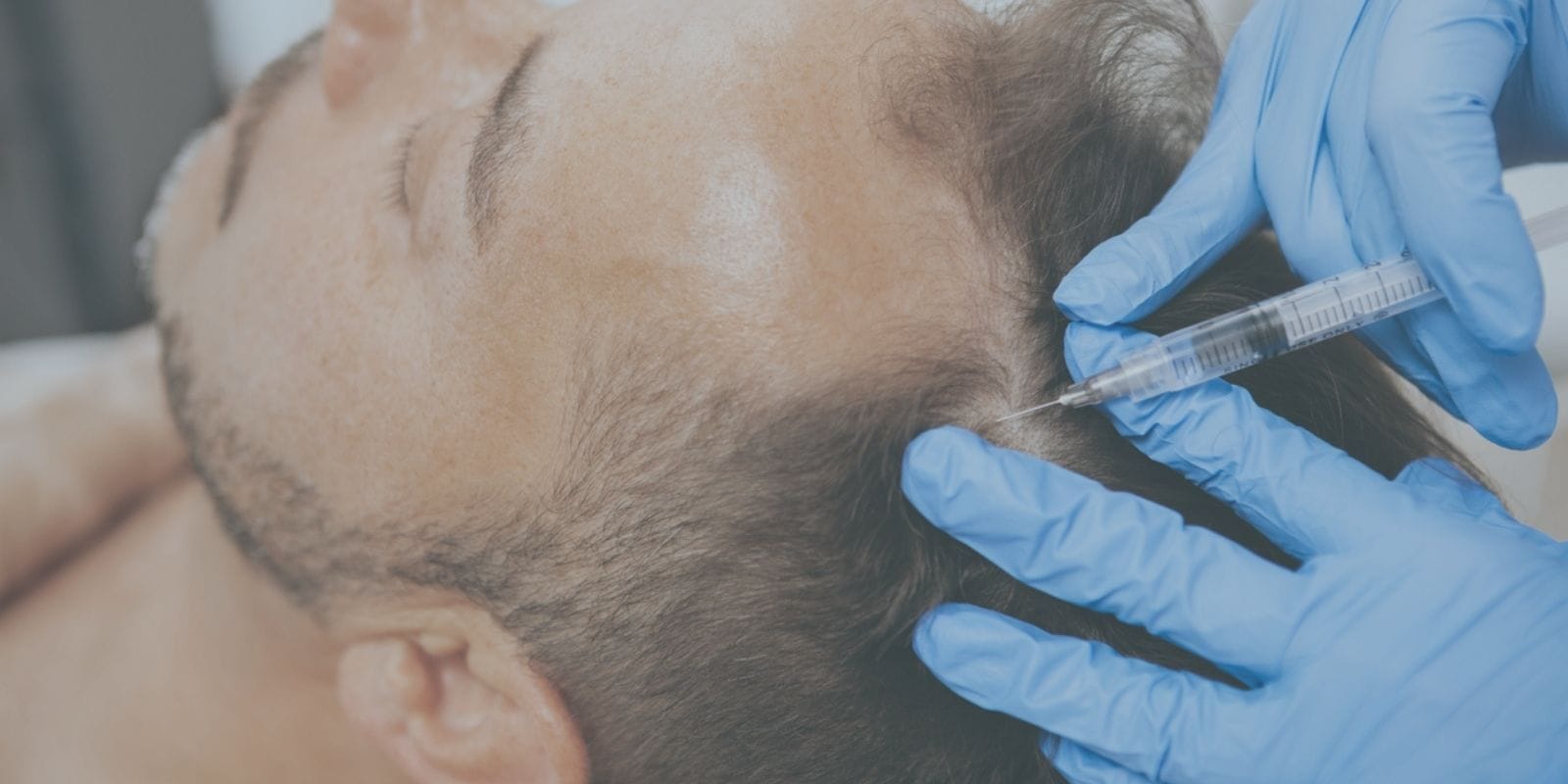 Man receiving a PRP injection for make hair loss in his hairline