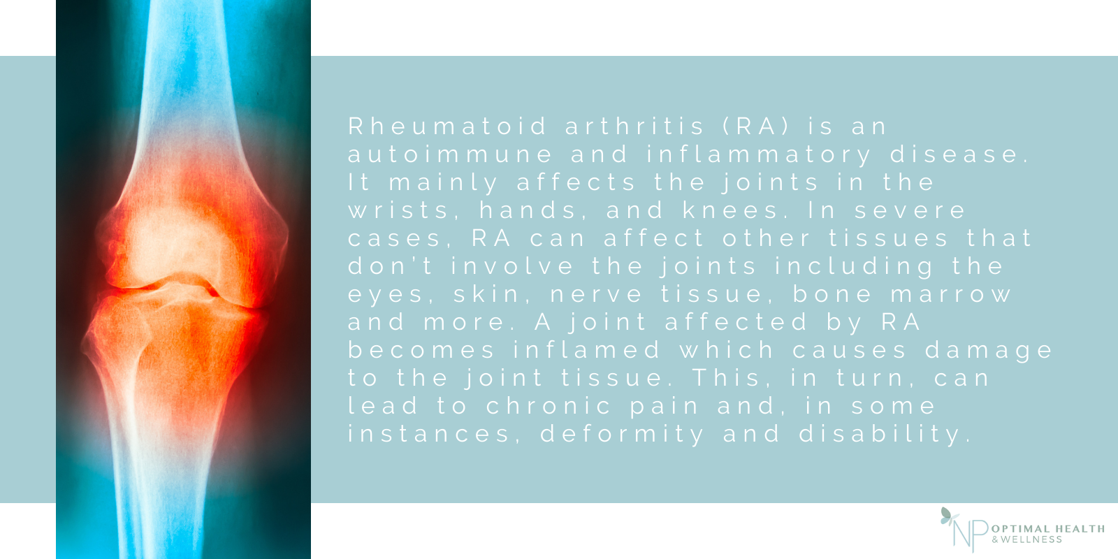 Rheumatoid arthritis is an auto-immune and inflammatory disease. 