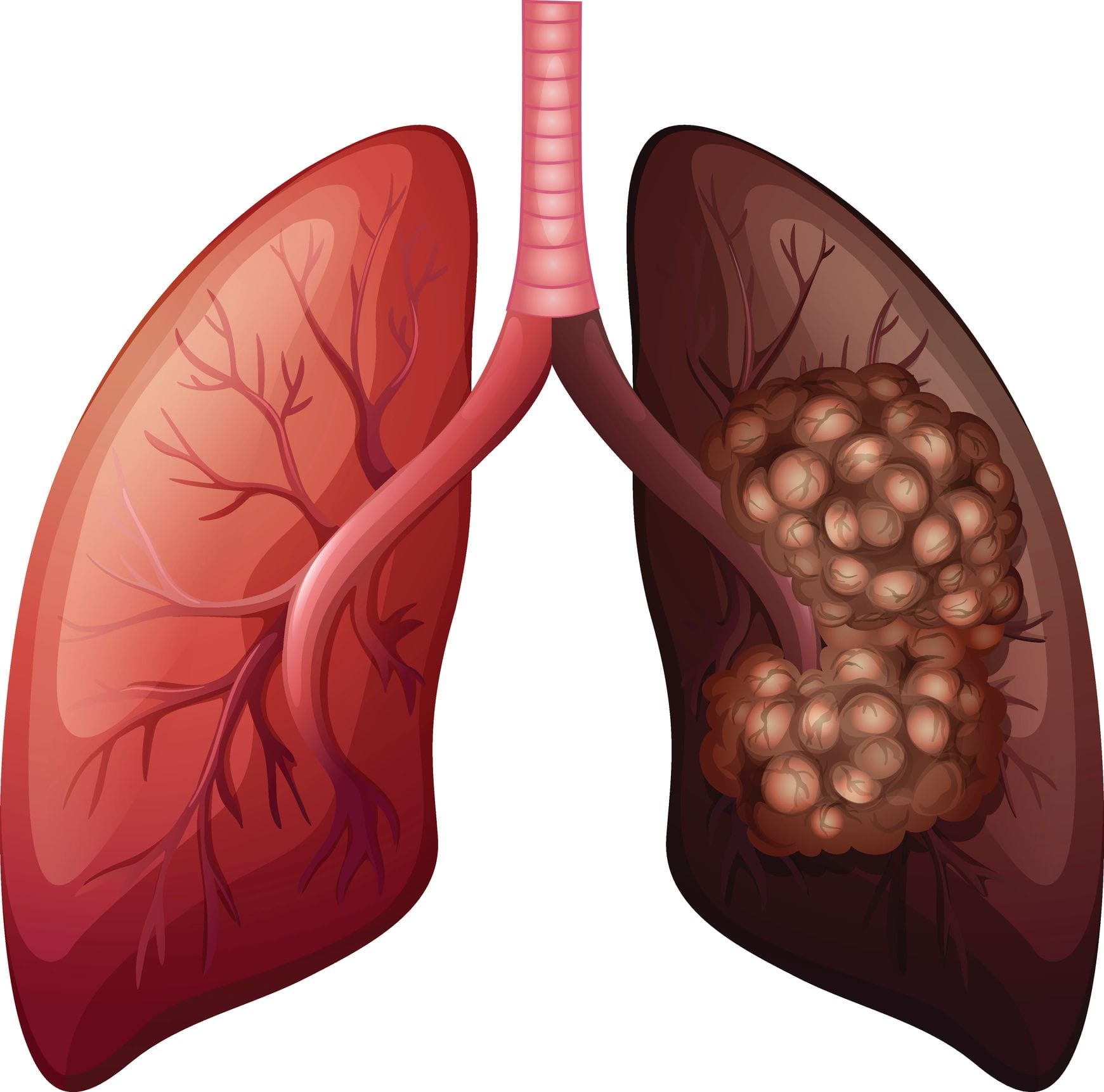 Chronic Respiratory Disease Meaning In Tamil