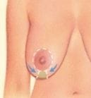Around the areola Around the areola