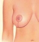 vertically down from the areola to the breast crease vertically down from the areola to the breast crease