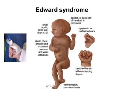 syndrome edward wrongful diagnosis errors antenatal genetic further therapeutic abortion reading