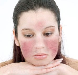 Как выглядит розацея на лице Rosacea Women