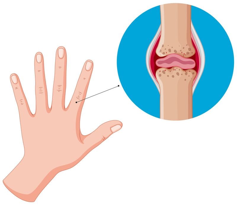 Can Stem Cell Injection Therapy Prevent Arthritis Pain?