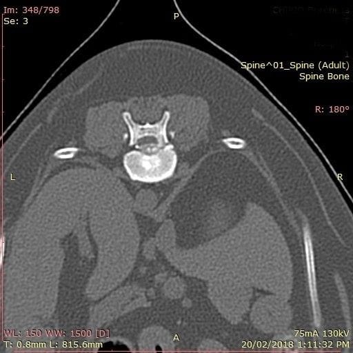 Essay On Intervertebral Disc Disease