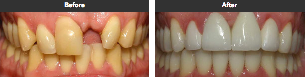 Before & After