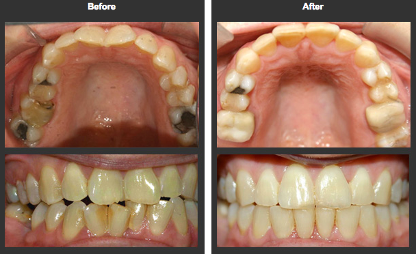 Before & After