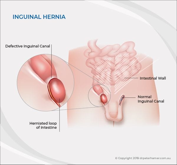 Inguinal Hernia What You Need To Know
