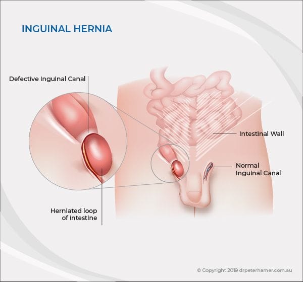 Laparoscopic Grion Hernia Repair Centro Medico Piedras Negras